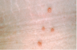 molluscum contagiosum on skin